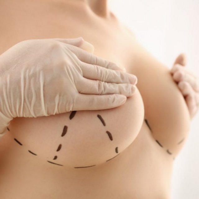 Chirurgie esthétique de réduction du sein